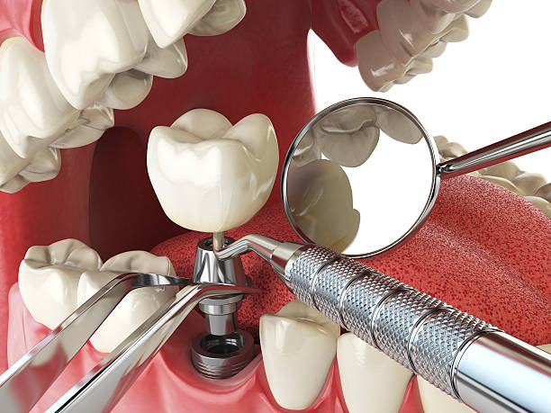 Best Emergency Root Canal Treatment in Oxford, MI